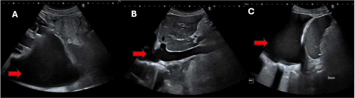 Presencia de líquido ascítico en distintos planos de la ecografía abdominal.